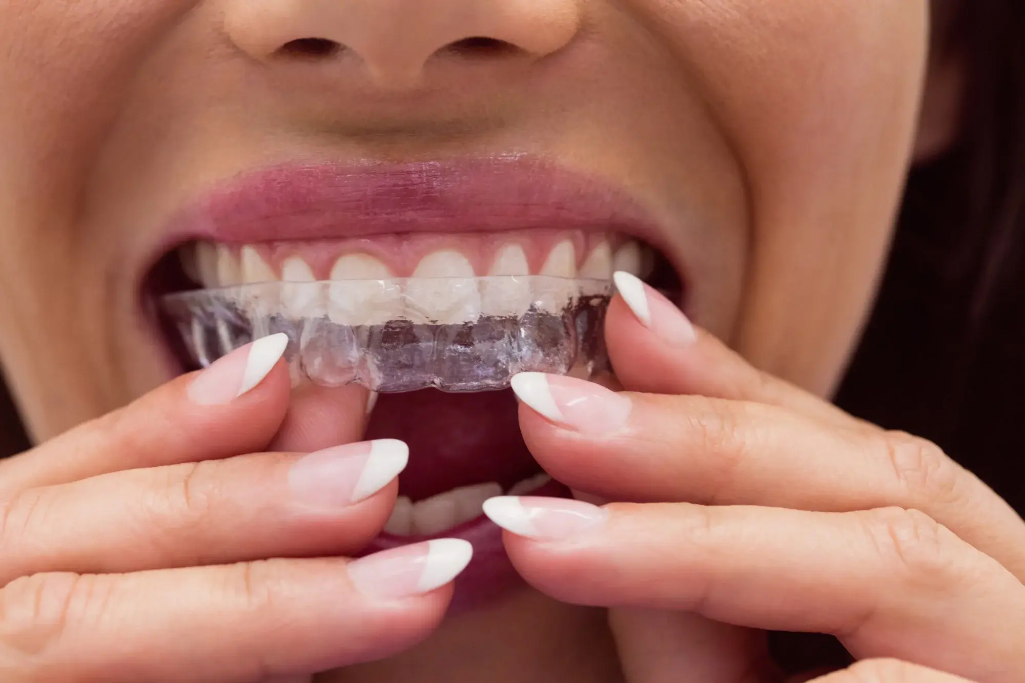 ortodonzia invisibile studio dentistico varacca maccarini