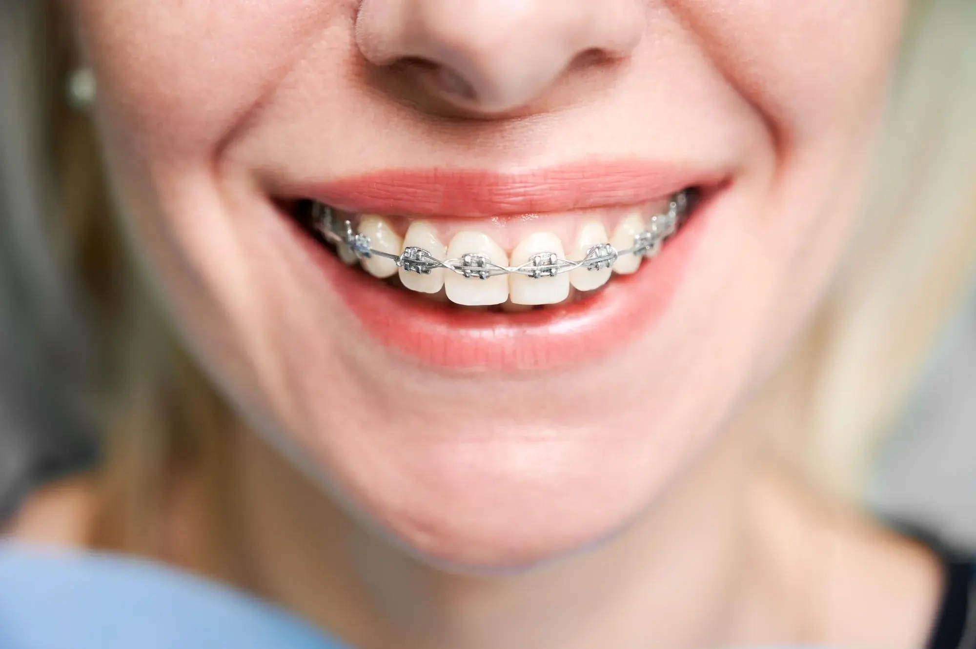ortodonzia tradizionale studio dentistico varacca maccarini